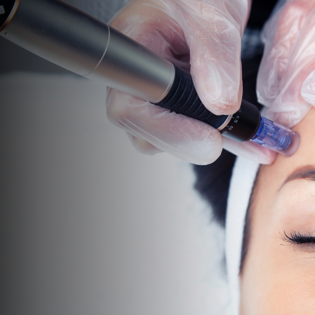 Dermapen e Fili di Collagene